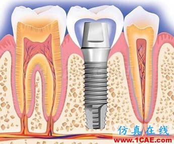 ansys對種植牙的仿真模擬ansys仿真分析圖片2